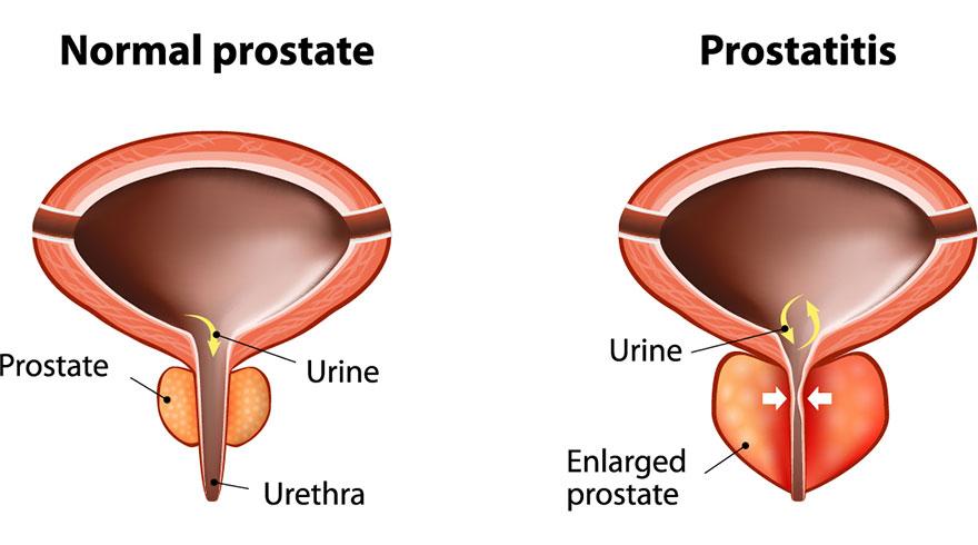 prostatitis és vér a végbélben gyakorlat krónikus prosztatitis