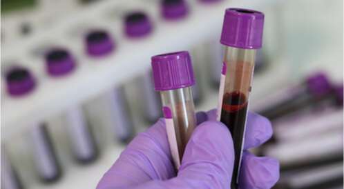 الاختلافات في قيم الاختبار لفقر الدم لدى الرجال والنساء