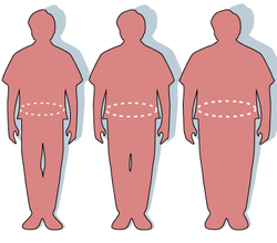 250px Obesity waist circumference