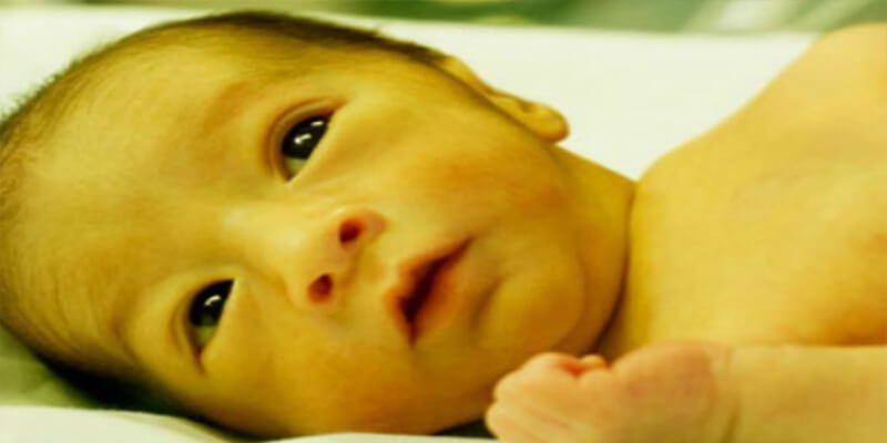 4 ways treat neonatal jaundice children