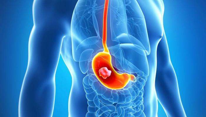 47 114240 stomach cancer causes symptoms