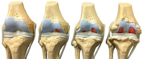 hip and knee arthritis 1 500x208 1